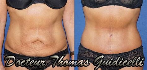 L'abdominoplastie ou dermolipectomie de l'abdomen peut apporter une solution à votre besoin. Avant Après Abdominoplastie Marseille