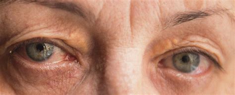 Sindrome di Sjögren: che cos'è, sintomi, cause, diagnosi e ...