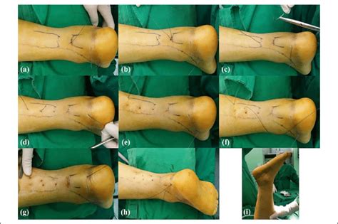 Treatment is with stretching, splinting, and heel lifts. Operative procedures of percutaneous repair under ...