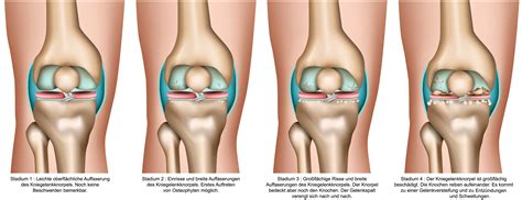 Unter anderem kann eine innenmeniskusläsion ursächlich sein. Knieschmerzen? Ursache, Behandlung und Übungen | Liebscher ...