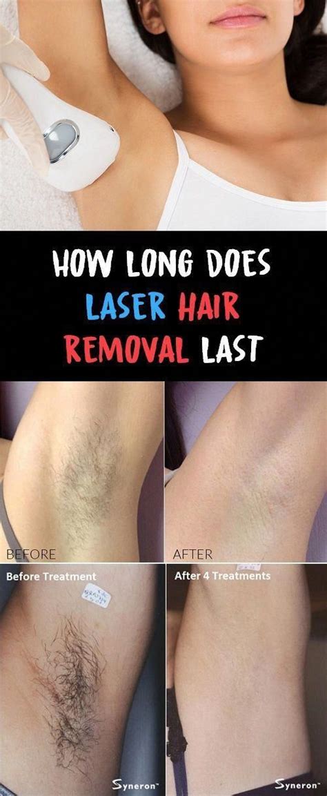 On wowcher i saw a really good deal for laser hair removal and thought getting laser hair removal would mean no more waxing, which in turn means no more bumps, scars and bad skin. Skin Discoloration After Laser Hair Removal - 125 Best ...