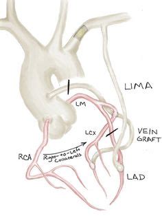 Mit dem begriff koronare herzkrankheit (altgriechisch κορώνα. Damus-Kaye-Stansel Procedure + Rastelli Repair for ...