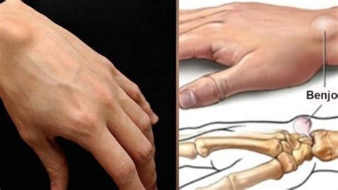 Dokumen, saya ingin bertanya sama ada terdapat benjolan di bawah dagu sebelum demam dan saya demam dan saya telah mengesahkan bahawa pembengkakan itu akan disebabkan oleh pham dan apabila saya mendapatkannya, bagaimana tekanannya sukar, doktor atau tidak? Cara Alami Menghilangkan Benjolan di Pergelangan Tangan ...