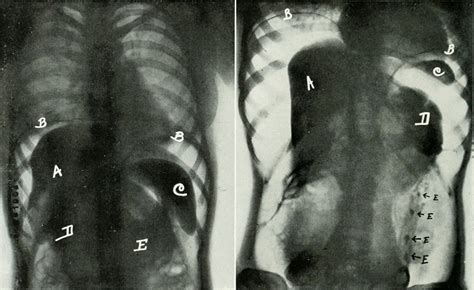 See full list on mayoclinic.org Signs of enlarged liver | General center | SteadyHealth.com