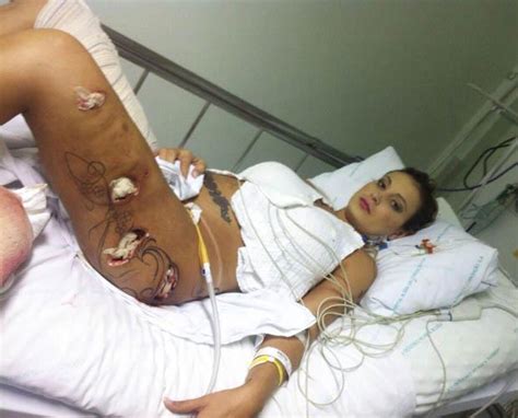Updated 6 days, 10 hours ago on tube8. When cosmetic surgery goes wrong: model left with holes in ...