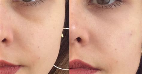 Dec 27, 2001 · —yes. REVIEW: Do tear trough fillers work? The small procedure ...