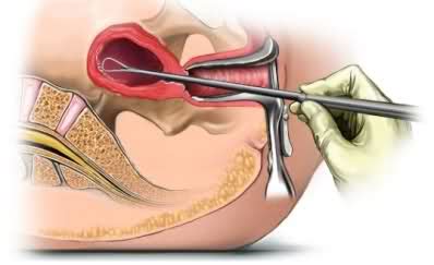 Is implantation an instantaneous thing that occurs within a second? What Does Bleeding After Having Endometrial Biopsy Means ...