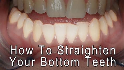 Dental implants are titanium posts that can be inserted into your jawbone. Dental Braces - How to Straighten your bottom front teeth - YouTube