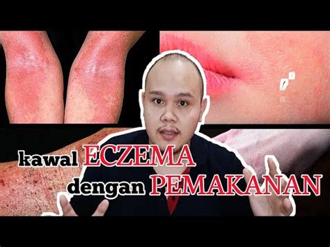 Lihat foto dan kenali gejala, cara mencegah, dan pengobatannya. DIET YANG SESUAI UNTUK PENYAKIT KULIT ECZEMA - Dr. ONE ...