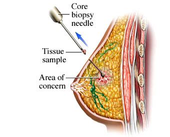 Breast cancer peau d'orange in the breast may be a symptom of inflammatory breast cancer. Breast Biopsy - what does it mean?