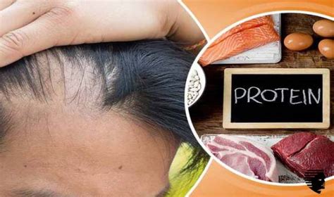 Hair loss is more common than you think and can happen to anyone. Can Protein Shakes be Responsible for Hair Loss? - AHS India