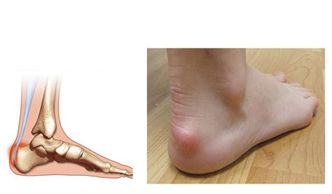 Haglund's deformity is also called haglund's disease and named after the swedish orthopedist patrick haglund. Haglunds Deformity Heel Pain | Country Foot Care