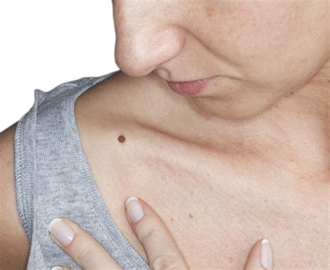 Learn what cancer is and what causes it. Signs and Symptoms of Melanoma Skin Cancer - Dr. Ankit jain