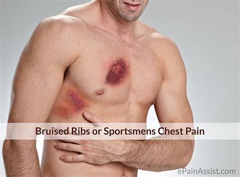 By describing your rib cage pain to your doctor as specifically as possible, you can help sprains and strains of intercostal muscles. Bruised Ribs or Sportsmen's Chest Pain|Causes|Risk Factors ...