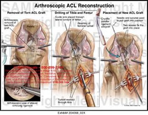 Acl reconstruction is best performed once the knee has recovered from the initial injury. Arthroscopic ACL Reconstruction Medical Illustration
