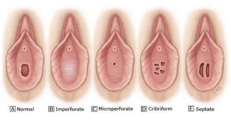 Internal hemorrhoids are usually painless, but tend to bleed. If hymen protects the vagina, then from which opening ...