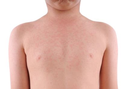 Dermatologinnen würden mehr patienten verzeichnen, die. Romania: Measles Resurgence and Media Lies - Word Matters!