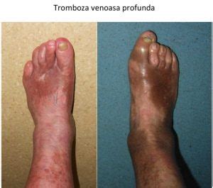 Stabilirea diagosticului de tromboza f. Tromboza venoasa profunda - Monturi picioare (Hallux ...