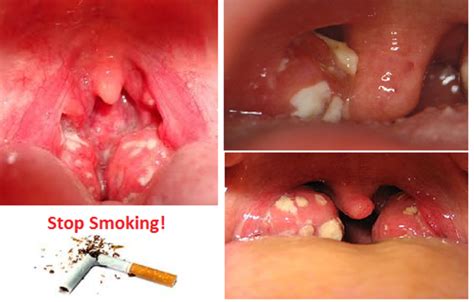 Most symptoms of throat cancer aren't specific to cancer, so you'll need to be extra vigilant about watching your oral cavity. Throat cancer: Causes, symptoms and treatment of ...
