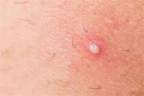 The ingrown hair cyst often misguided pilonidal cyst and sebaceous cysts. Causes, Symptoms and Treatment of Ingrown Hair