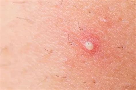 Ready to knock those ingrown hairs out for good? Causes, Symptoms and Treatment of Ingrown Hair