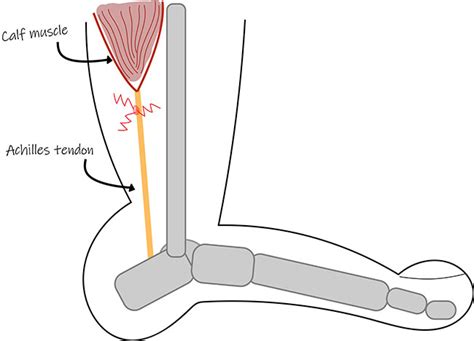 The achilles tendon (tendo calcaneus or tendo achillis) is the thickest and strongest tendon in the human body. Achilles tendon pain? Which type do you have? - Sundial ...