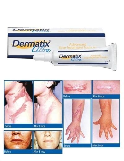Be the best version of yourself with dermatix® acne scar's, proven to visibly reduce acne scars in 4 weeks. Qoo10 - 15g DERMATIX ULTRA - ADVANCED SCAR GEL REDUCTION ...