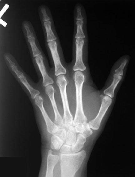 Check spelling or type a new query. Radiographic Anatomy of the Skeleton: Hand ...