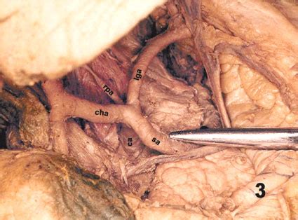 To study accurately the celiac trunk (ct) morphometry: Origen de las Arterias Frénicas Inferiores en el Tronco ...