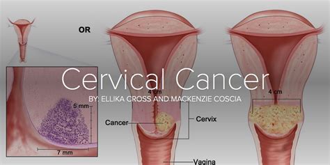 But if they aren't treated, there is a chance that these abnormal changes may become cervical cancer. Cervical Cancer