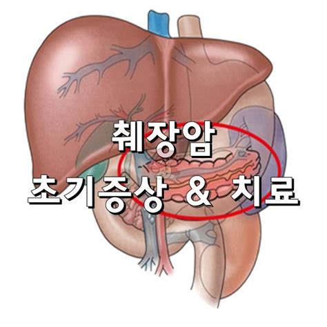 국내 췌장암 환자들 중 수술이 가능하게 운 좋게 발견되는 경우는. 췌장암 초기증상 & 치료