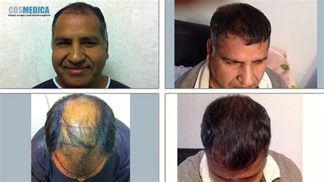 11 best clinics for afro hair transplant in turkey. Cosmedica Hair Transplant Clinic Turkey | HairSite.com