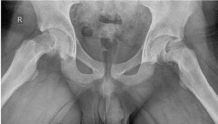 Some departments will perform this routinely instead of the ap pelvis view to reduce exposure and maintain high diagnostic accuracy 1. Bilateral slipped capital femoral epiphysis. This frog ...