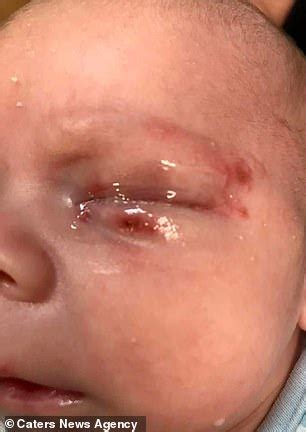 We'll explain how herpes simplex is transmitted, symptoms, and treatment options. Newborn baby almost dies after contracting herpes in his ...
