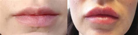 Maybe you would like to learn more about one of these? Lip Fillers - Med Fiore Aesthetic Clinic based in Hale ...