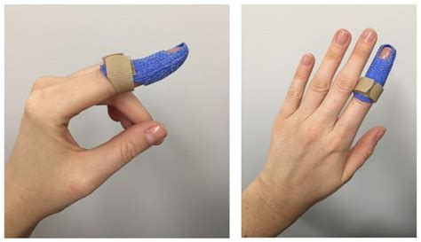 This is the tendon that pulls the fingers toward the palm after the surgery is completed, the doctor will apply a dressing and splint to protect the finger. Mallet Finger Splint | Terapia ocupacional, Manos y Terapia