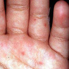 A blister is a friction injury to the skin that usually fills with water. Welcome to our Class 6.5 (2008) blog: January 2008