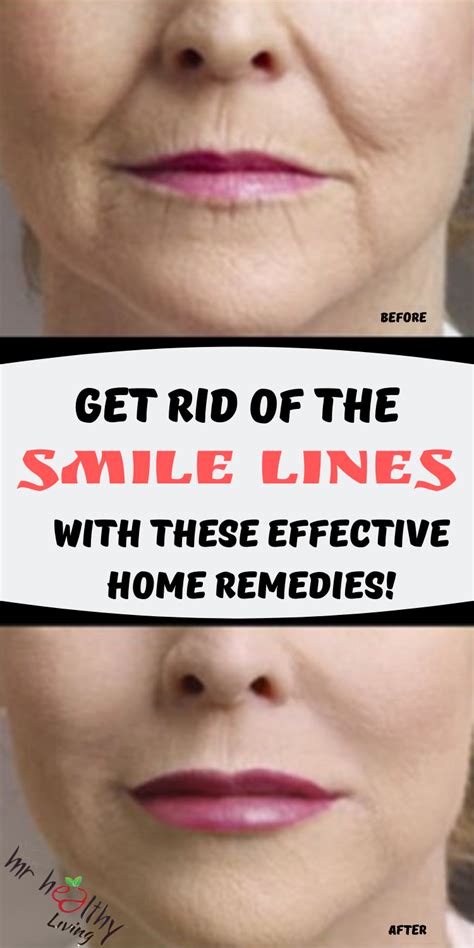 Pimples are formed due to bacteria that get mixed with hyperactive oil glands and hair follicle when your body sheds dead skin cells. Get rid of the smile lines with these effective home ...
