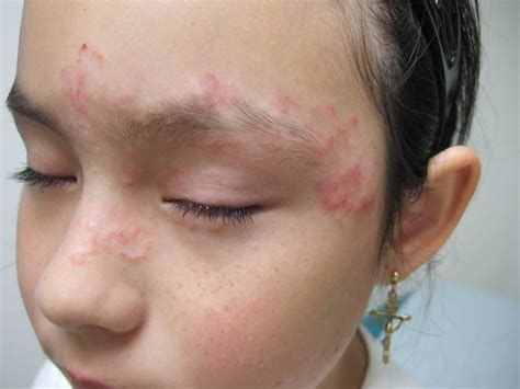 Complications of pityriasis rosea aren't likely. Pityriasis Rosea - Causes, Rash, Herald Patch, Stages ...