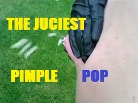 However, when it turned out to be a big ball of crusty pus she took matters into her own hands. BIGGEST CYST POP EVER - MAN-TIT ON BACK (Episode #1 ...