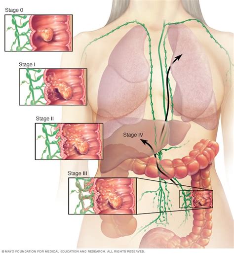 It usually begins as small, noncancerous (benign) clumps of cells called polyps that form on the inside of the colon. Colon cancer Disease Reference Guide - Drugs.com