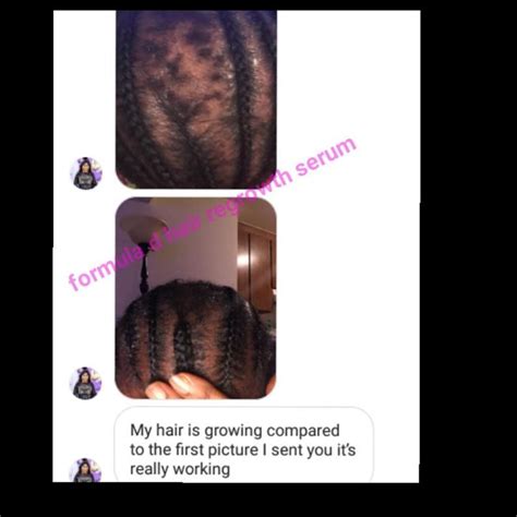 The activated herbal oils thicken and repair the existing hair blend of nutrients aids regrowth of damaged hair follicles. Formula D Hair ReGrowth Serum For CCCA- Baldspots-BigChop ...