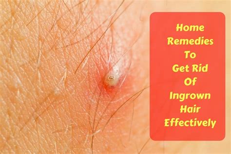 Before you get rid of ingrown hairs, care should be taken to prevent problems in the future. 23 Home Remedies To Get Rid Of Ingrown Hair Effectively