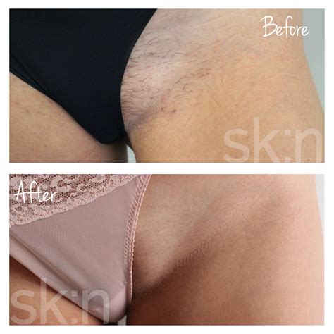 Acne, acne scaring, skin tag, wart & birthmark removal treatments pricing; Case study: Laser hair removal for bikini line | sk:n clinics