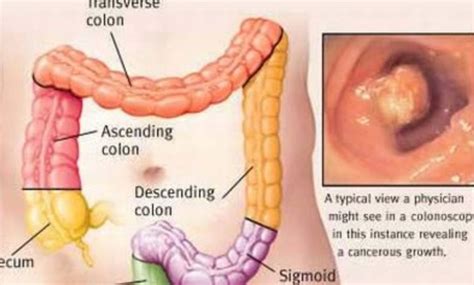 The warning signs of cancer in dogs are very similar to that in people. Understanding common signs and symptoms of colon cancer ...