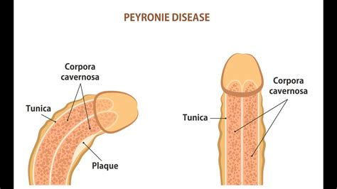 Ordinary people buy more when price falls and less when price rises. P-SHOT for Peyronie Disease - Correct the bend in your ...