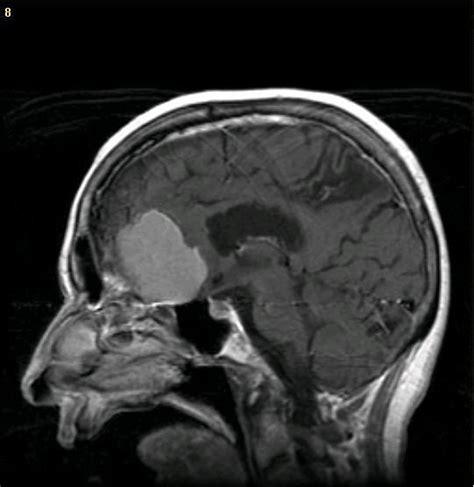 Schwartz says some genetic disorders can lead to brain tumors. Save Send Delete: "I was 17 and Worried about My Hair ...