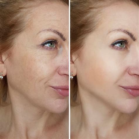 In women, androgen blockers can improve the symptom of unwanted facial hair (hirsutism), usually associated with pcos. PHOTOREJUVENATION - Laser Hair Removal | Doucet Medical Spa