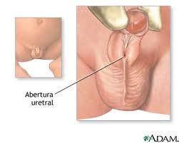 ● hipospadias mutlaka düzeltilmesi, cerrahi olarak tedavi edilmesi gereken bir anomalidir. Esperando a Abraham: Necesidades Especiales