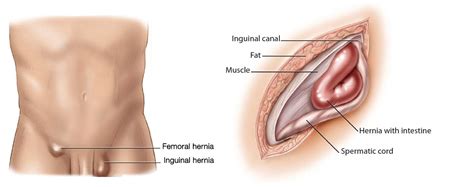 The groin is the area that lies between the abdomen stomach and thighs. Inguinal Hernia: Diagnosis & Treatment - Scottish Hernia ...